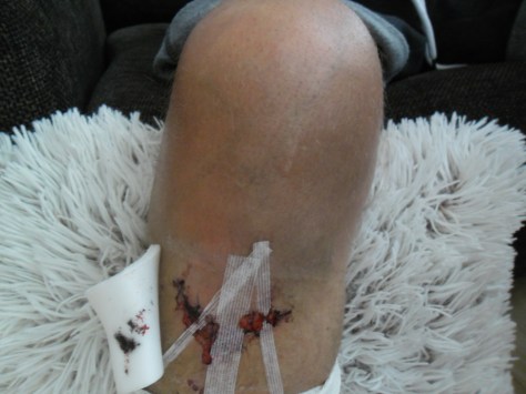 - Av siger fjolset her: 7 sting og lidt tape skulle der til. NEDTURSAGTIGT!!!